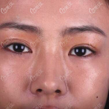 做雙眼皮修復術(shù)前照 做雙眼皮修復術(shù)前照