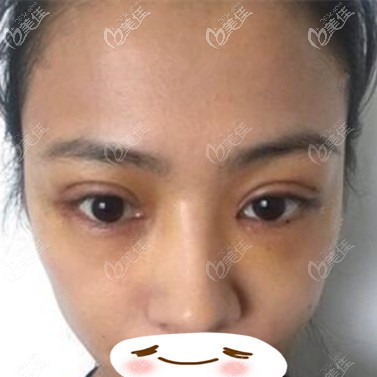 雙眼皮修復術(shù)后5天效果照 雙眼皮修復術(shù)后5天效果照