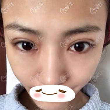 雙眼皮修復術(shù)后10天照 雙眼皮修復術(shù)后10天照