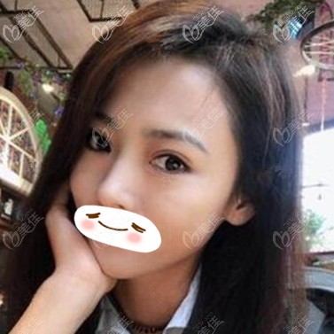 雙眼皮修復術(shù)后20天恢復效果照 雙眼皮修復術(shù)后20天恢復效果照