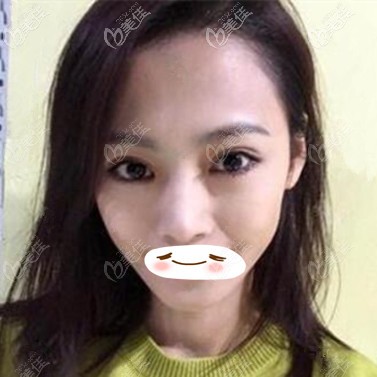 眼修復術(shù)后30天效果照 眼修復術(shù)后30天效果照