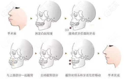 正頜手術(shù)的過程