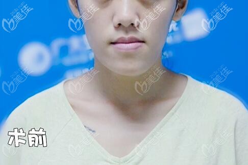 骨性地包天正面臉型