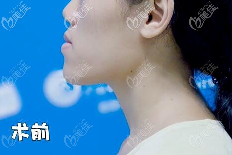 骨性地包天側(cè)面照片