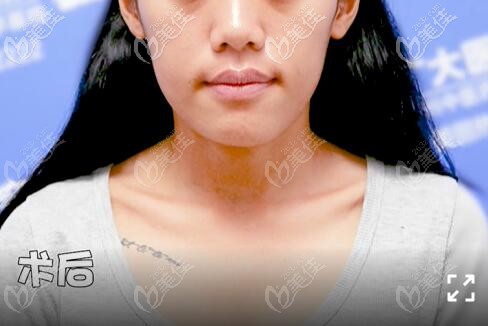 骨性地包天做正頜手術(shù)后40天正面臉型