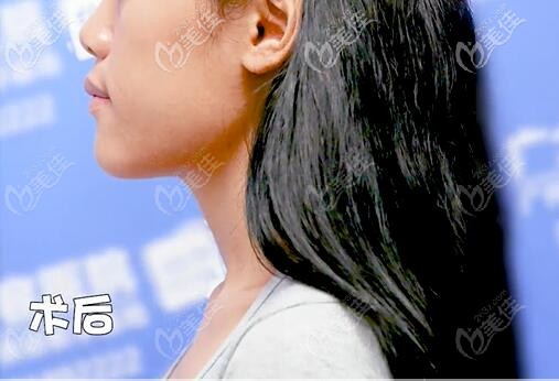 骨性地包天正頜手術(shù)后側(cè)面樣子