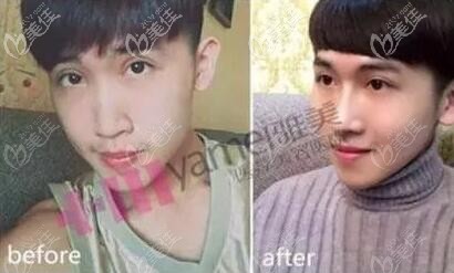 雅美田芳斌隆鼻真人前后對比案例圖