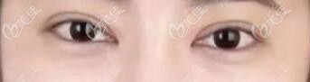 葉薇薇割雙眼皮真人術(shù)后恢復(fù)照 葉薇薇割雙眼皮真人術(shù)后恢復(fù)照
