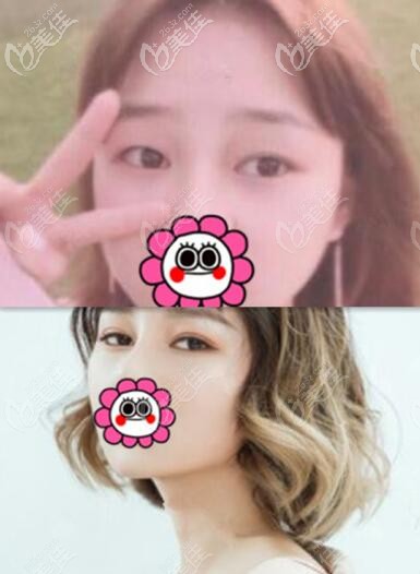 長沙協(xié)雅明經(jīng)發(fā)雙眼皮真人前后對比效果照 長沙協(xié)雅明經(jīng)發(fā)雙眼皮真人前后對比效果照