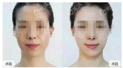 臉型長做脂肪填充后的效果對比 臉型長做脂肪填充后的效果對比