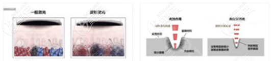 激光祛疤改善過(guò)程示意圖 激光祛疤改善過(guò)程示意圖