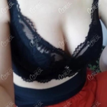天生胸小的我在沈陽美萊做完曼托假體隆胸之后感覺醫(yī)院挺靠譜的，高國林技術(shù)也好！