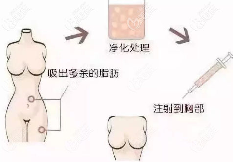新維度自體脂肪豐胸手術(shù)過程示意圖