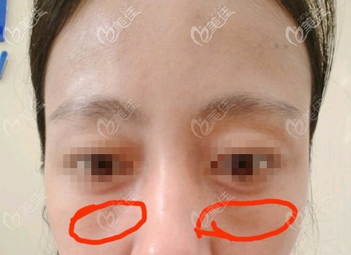 眶隔釋放1個(gè)月淚溝明顯