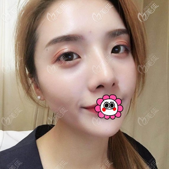 臺(tái)州藝星耳軟骨隆鼻效果怎么樣 臺(tái)州藝星耳軟骨隆鼻效果怎么樣