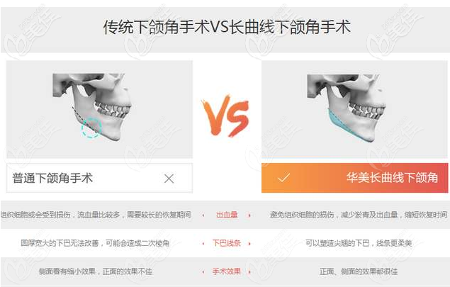 長曲線下頜角手術(shù)對比傳統(tǒng)下頜角手術(shù)優(yōu)勢 長曲線下頜角手術(shù)對比傳統(tǒng)下頜角手術(shù)優(yōu)勢