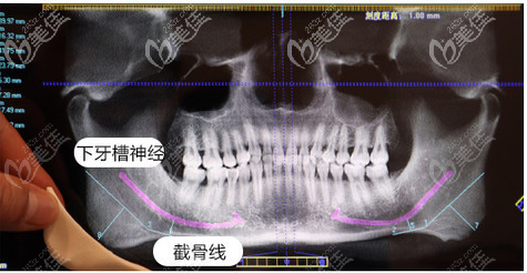 找高俊明做下頜角術(shù)前拍ct