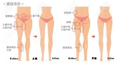 大腿吸脂的范圍 大腿吸脂的范圍