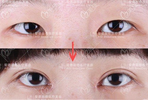 大連愛德麗格馮勇雙眼皮案例 大連愛德麗格馮勇雙眼皮案例
