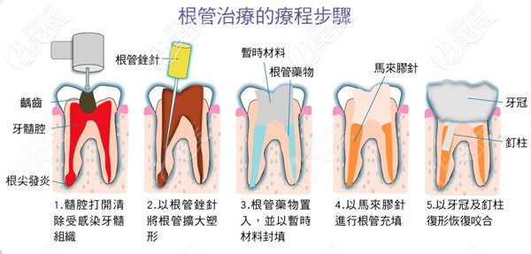根管治療的過程步驟圖