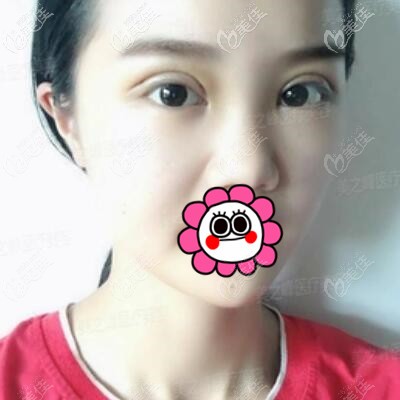 割雙眼皮術(shù)后3天效果照