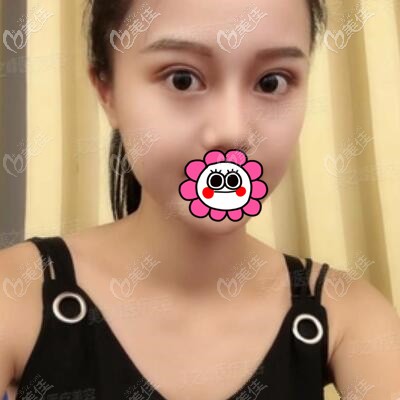 割雙眼皮1個(gè)月時(shí)的恢復(fù)效果照