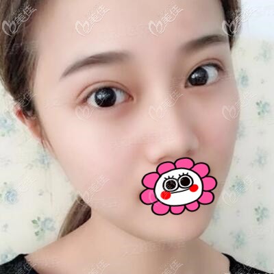 嗯，找長沙名氣好的雙眼皮醫(yī)生劉磊給我做的MINI微創(chuàng)切開雙眼皮效果真好！