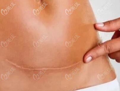 剖腹產(chǎn)后出現(xiàn)的增生疤痕 剖腹產(chǎn)后出現(xiàn)的增生疤痕