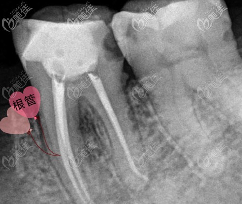 一顆牙根管再治療的費(fèi)用在1000元~1800元左右