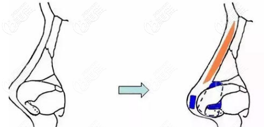 超肋隆鼻手術(shù)效果