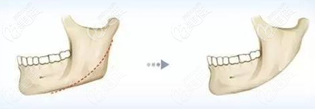 長曲線截骨手術(shù)效果 長曲線截骨手術(shù)效果