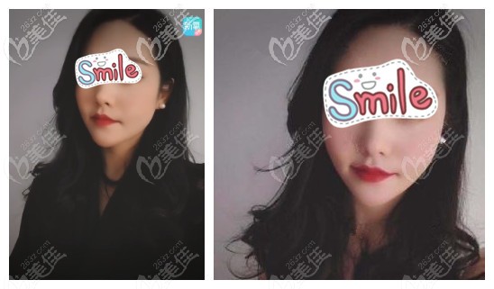 全臉埋線提升術(shù)中放了12根大V線后皮膚不僅光滑緊致就連明顯的鼻唇溝也不見(jiàn)了