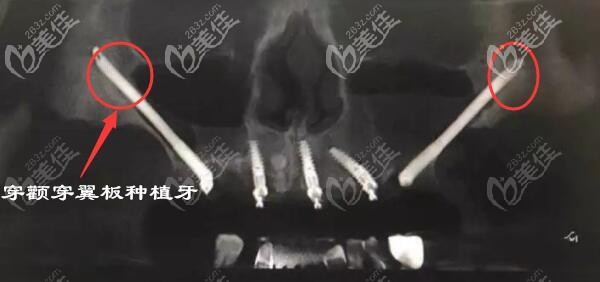 深圳登緹斯口腔穿顴穿翼種植牙