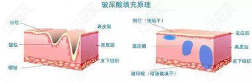 玻尿酸填充凹陷手術(shù)原理