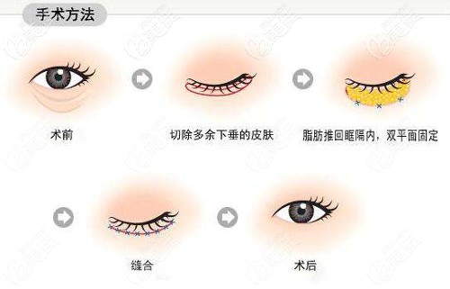 外切去眼袋的手術(shù)原理圖