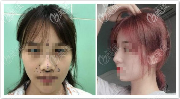 美國(guó)舒鉑鼻綜合案例效果圖