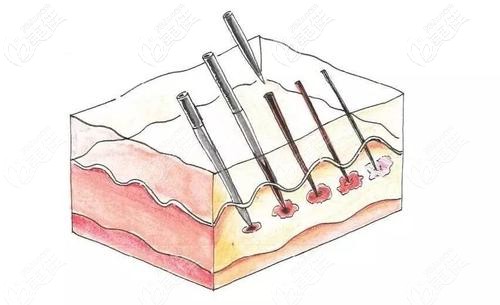 微針治療黃褐斑