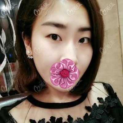 做埋線雙眼皮術(shù)前照 做埋線雙眼皮術(shù)前照