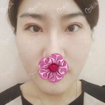 埋線雙眼皮術(shù)后1天效果 埋線雙眼皮術(shù)后1天效果