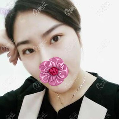 埋線雙眼皮術(shù)后一周恢復(fù)效果照 埋線雙眼皮術(shù)后一周恢復(fù)效果照