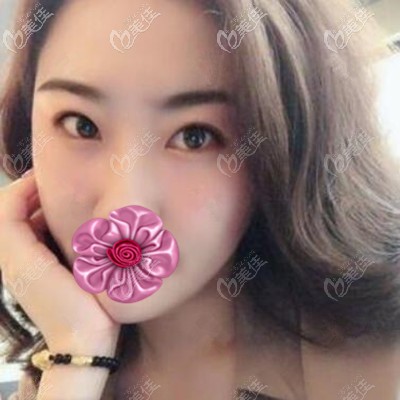 做埋線雙眼皮術(shù)后18天恢復(fù)效果照 做埋線雙眼皮術(shù)后18天恢復(fù)效果照