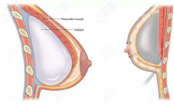 假體隆胸的位置 假體隆胸的位置