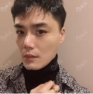 看我在廣州市佳人整形醫(yī)院做的假體墊眉弓效果怎么樣