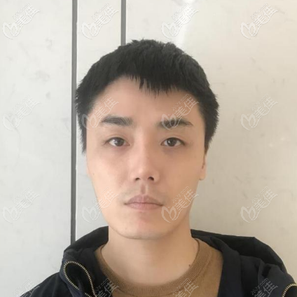 分享我做假體墊眉弓的親身經(jīng)歷