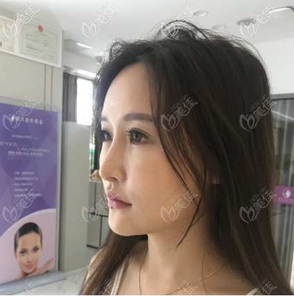 給你看看我做假體墊眉弓術前照片