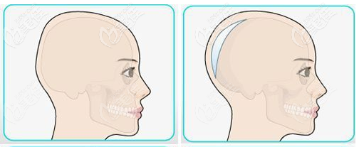 骨水泥后腦勺填充術效果演示圖 骨水泥后腦勺填充術效果演示圖