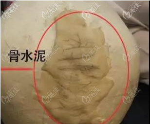 骨水泥后腦勺填充術之骨水泥實物效果 骨水泥后腦勺填充術之骨水泥實物效果