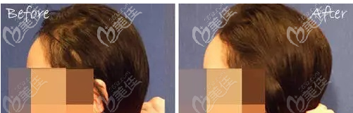 成年人扁頭變圓頭的成功案例 成年人扁頭變圓頭的成功案例