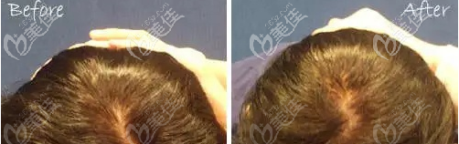 骨水泥后腦勺填充案例 骨水泥后腦勺填充案例