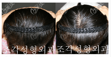 我扁頭變圓頭矯正成功案例 我扁頭變圓頭矯正成功案例